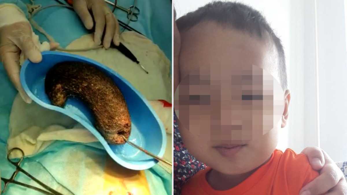 Полтора килограмма волос извлекли хирурги из желудка 4-летнего казахстанца