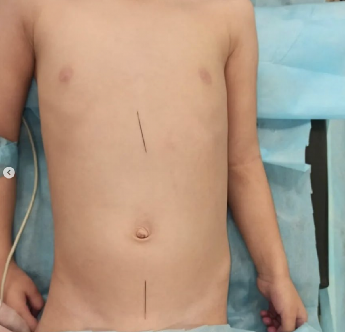Таразские врачи спасли 3-летного ребёнка, проглотившего швейные иглы