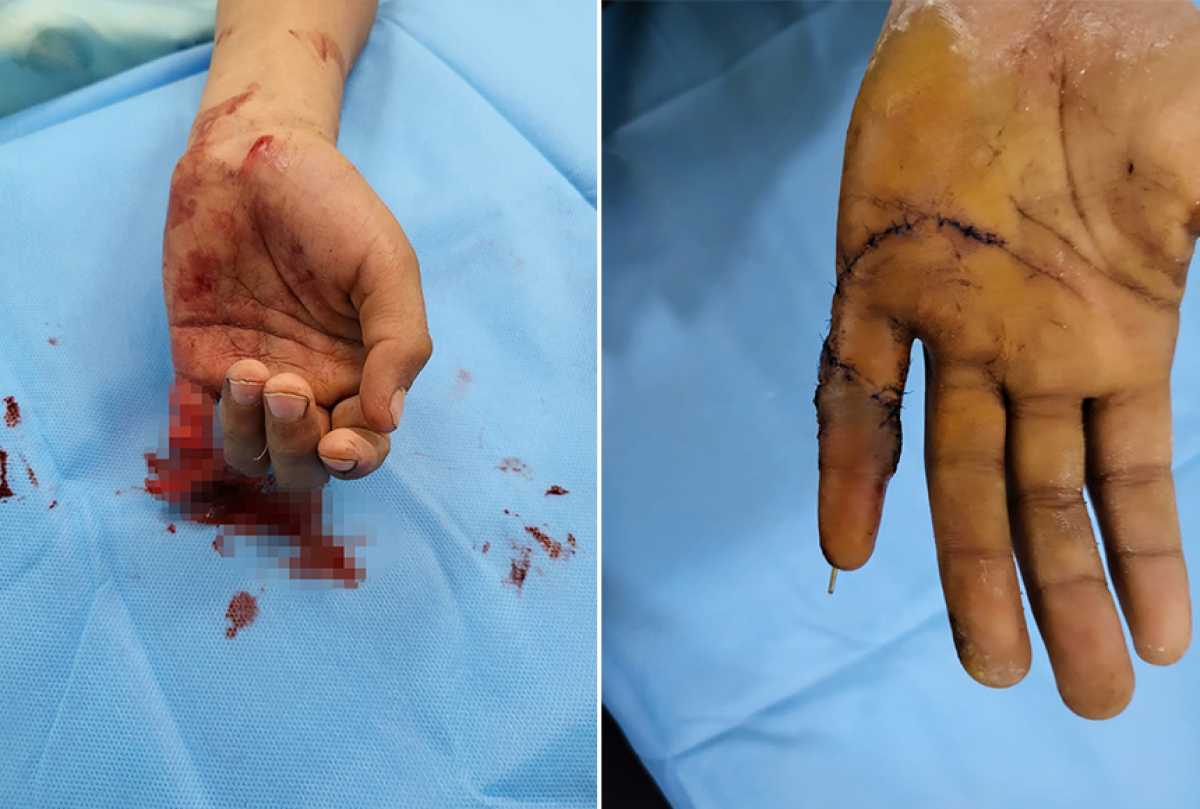 Микрохирургическую операцию по реплантации пальца кисти ребенку впервые провели алматинские медики