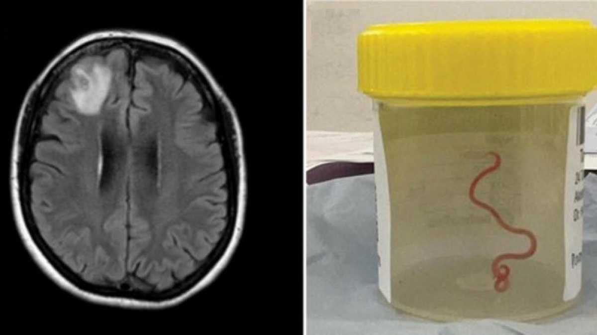 Впервые в мире из мозга пациентки извлекли живого червя