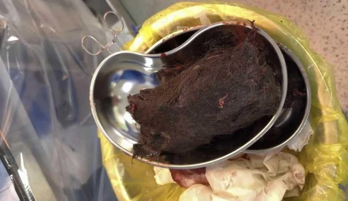 Почти килограмм волос обнаружили в желудке у девочки в Туркестанской области