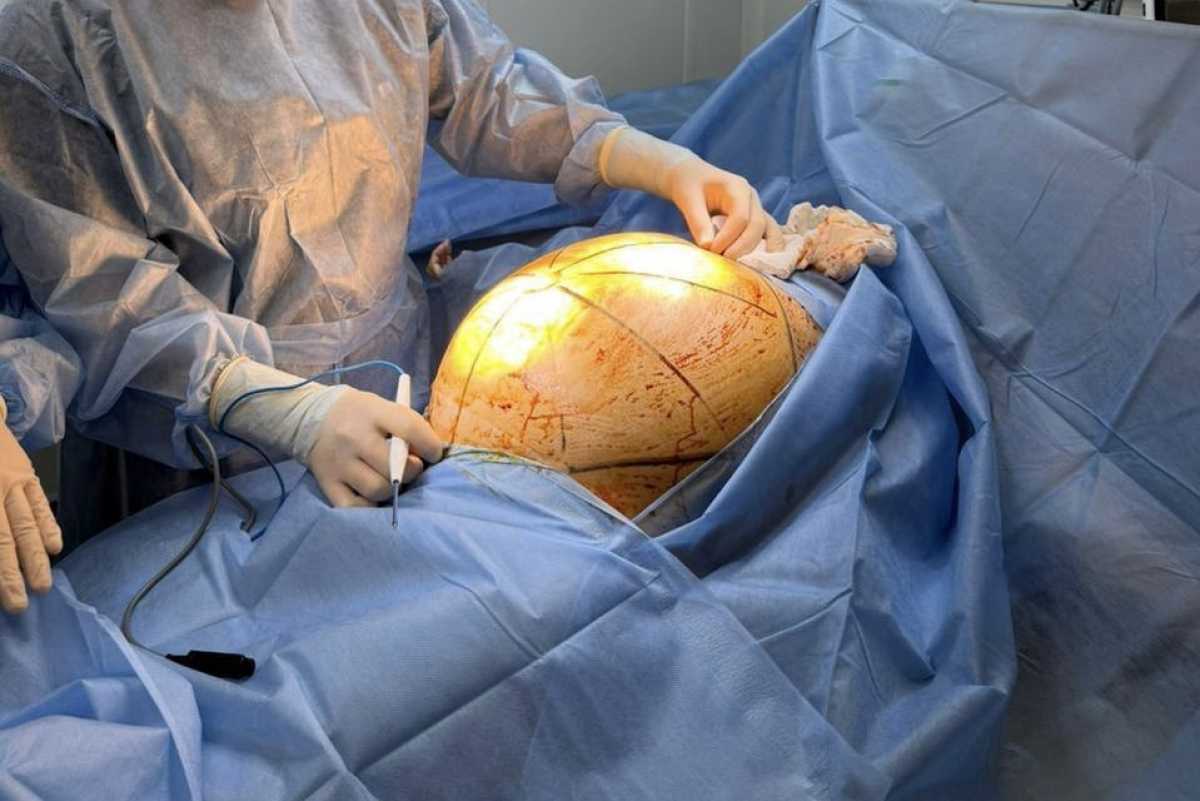 В Алматы пациентке удалили 25-килограммовую опухоль